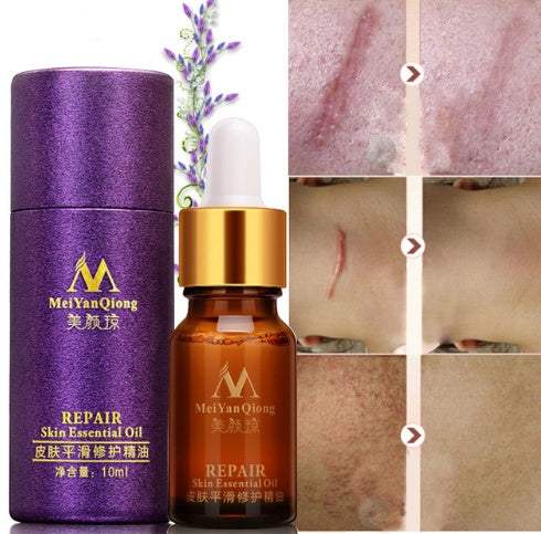 Scar Skin Repair Essential Oil Lavender Care Natural Skin Pure Remove Ance Burn Strentch Marks Removal Scar 10 ML - Peakshop